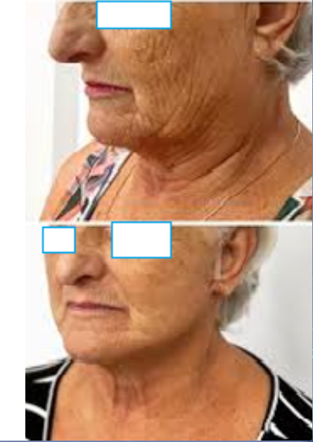 O procedimento