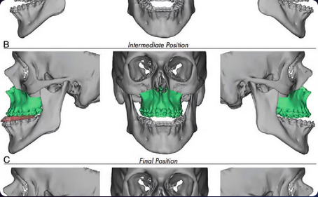 Cirurgia Ortogn&aacute;stica